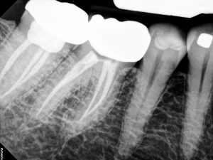 Image produced by Carestream Dental RVG 6500 System