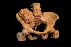 3d-printed model of a pelvis with ossified tumour - created using Bespoke Modeling service from - created using 3D Systems