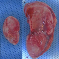 Artificial Ear - 3d-printed from living cartilage cells